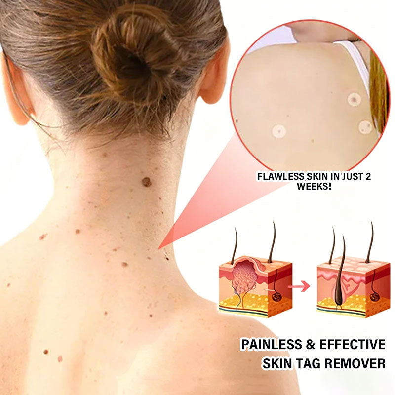 Acne and Wart Removal Microneedle Hydrocolloid Patches | - 🛒Buy One Get One Free (2 Boxes)🎁