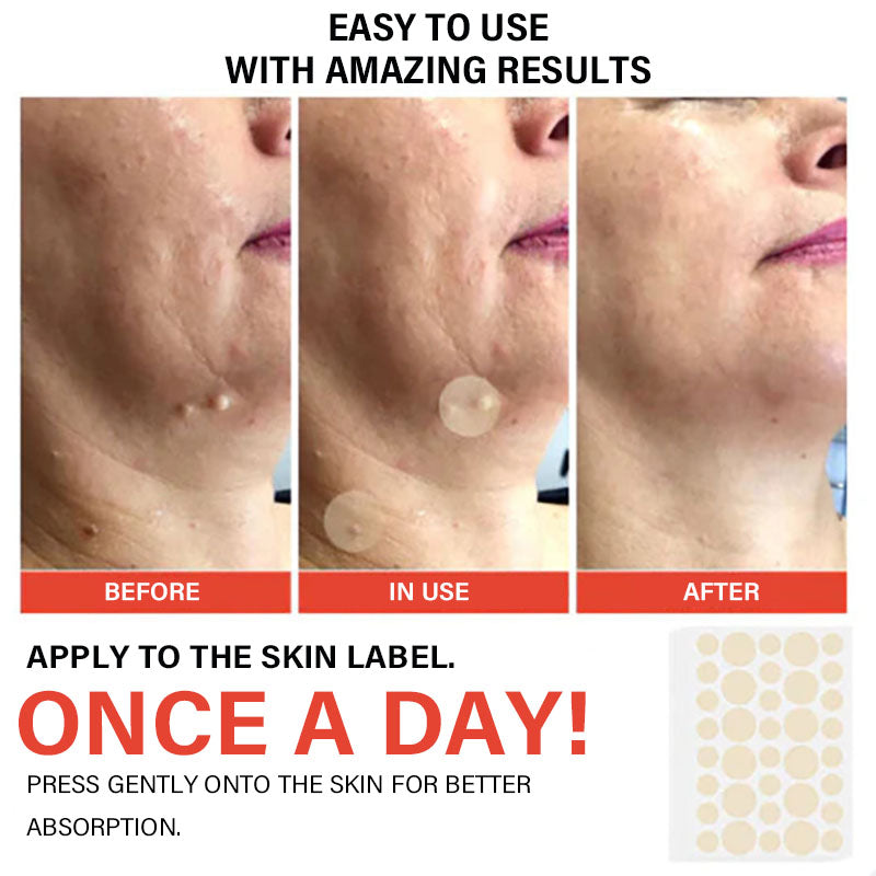 Acne and Wart Removal Microneedle Hydrocolloid Patches | - 🛒Buy One Get One Free (2 Boxes)🎁