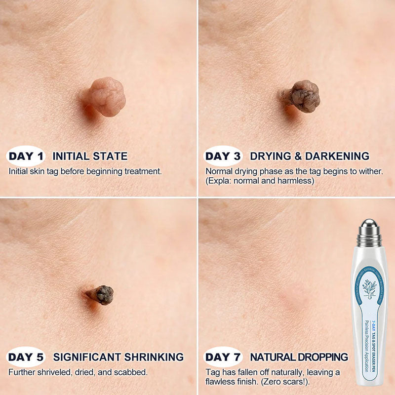 Advanced rollerball product for removing moles and warts