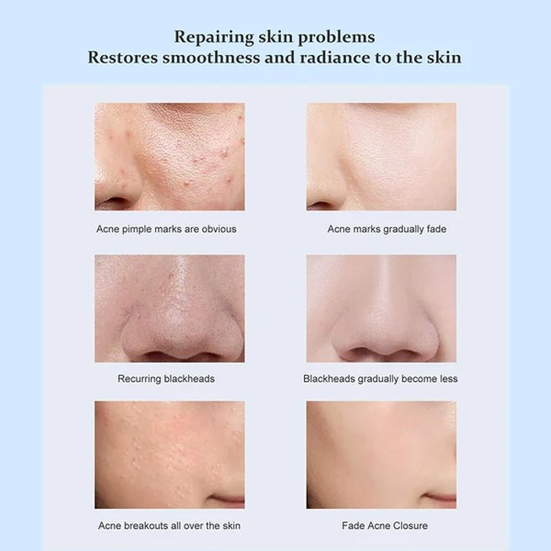 Salicylic Acid Ice Cream Mask (BUY 1 GET 1 FREE)